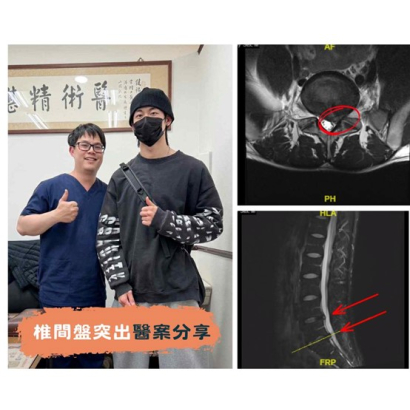 腰椎椎間盤突出 - 醫案二