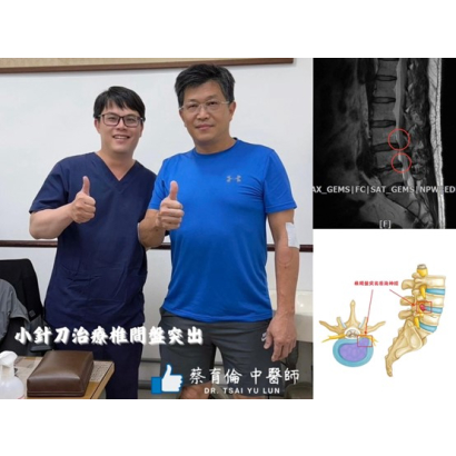 腰椎椎間盤突出 - 醫案三