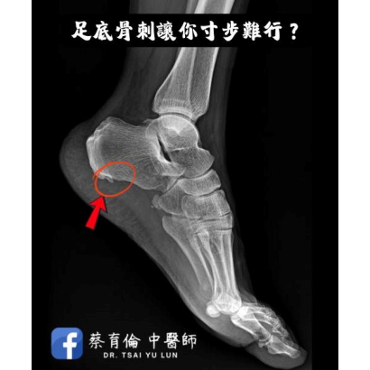 足底筋膜炎 - 醫案一