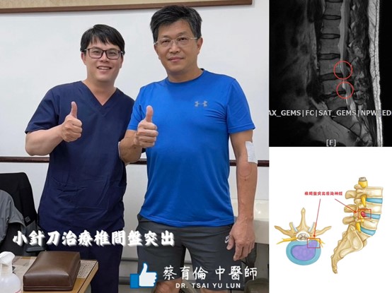椎間盤突出針刀治療案例照片