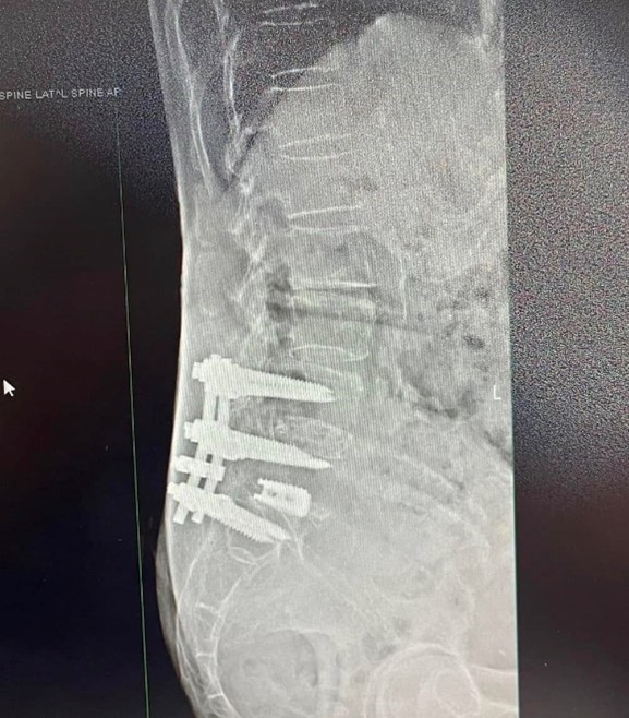 椎間盤突出手術後治療照片3