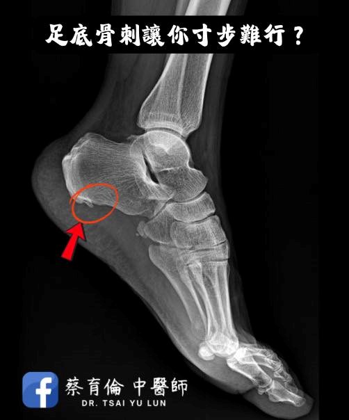 足底筋膜炎治療紀錄