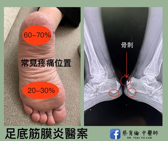 足底筋膜炎治療紀錄