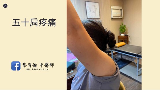 五十肩活動受限示意